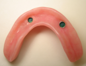 denture with male implant attachment